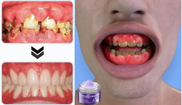 AQA™ Teeth Restoration Powder – Dentist-Approved Enamel Repair (CDA Certified) 🦷 | Flash Sale Today Only!